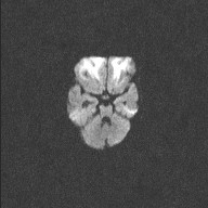 File:Neonatal hypoxic-ischemic encephalopathy (Radiopaedia 41406-44277 Axial DWI 14).jpg