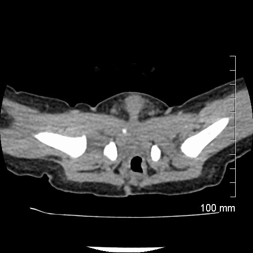 File:Neonatal neuroblastoma (Radiopaedia 56651-63438 Axial non-contrast 82).jpg