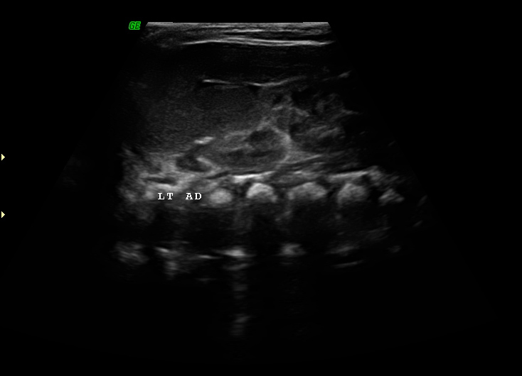 File:Neonatal neuroblastoma (Radiopaedia 9564-10221 A 11).jpg
