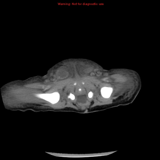 File:Neonatal neuroblastoma (Radiopaedia 9564-10223 A 45).jpg