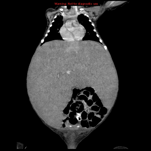 File:Neonatal neuroblastoma (Radiopaedia 9564-10223 B 54).jpg