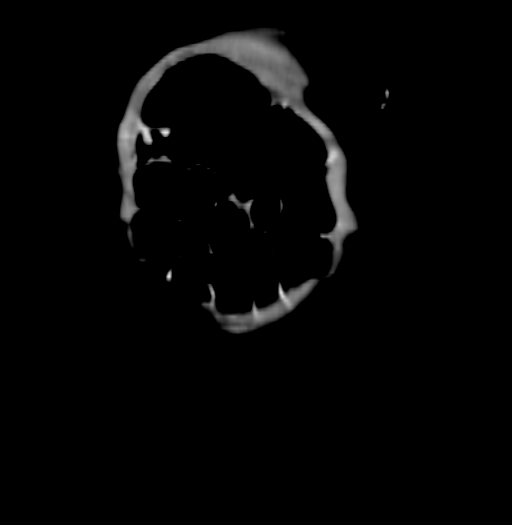 Nephroblastomatosis (Radiopaedia 71294-81607 B 26).jpg