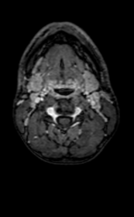 Neuro-Behçet disease (Radiopaedia 90112-107294 Axial T1 C+ 252).jpg