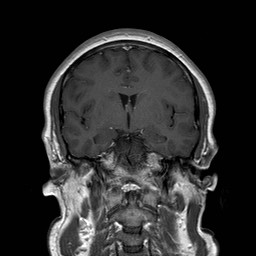 File:Neuro-Behcet's disease (Radiopaedia 21557-21505 Coronal T1 C+ 9).jpg