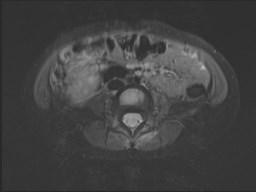 File:Neuroblastoma with bone metastases (Radiopaedia 67080-76414 Axial STIR 64).jpg