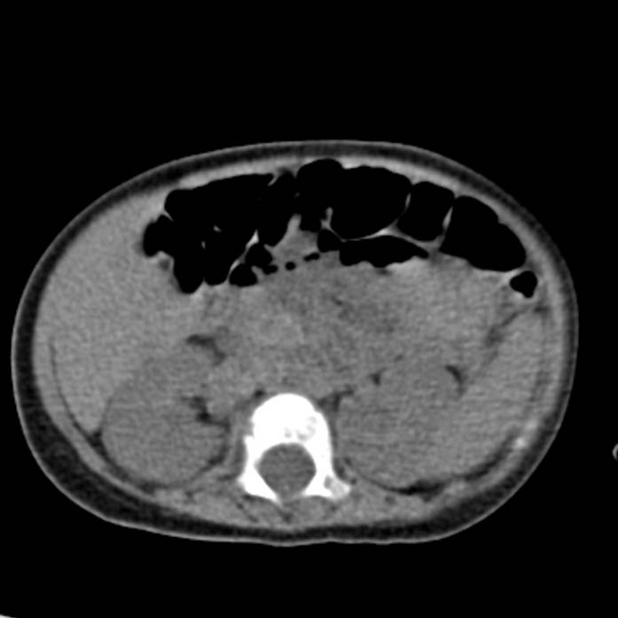 Neuroblastoma with skull metastases (Radiopaedia 30326-30960 Axial non-contrast 27).jpg