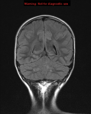 File:Neurofibromatosis type 1 with optic nerve glioma (Radiopaedia 16288-15965 Coronal FLAIR 7).jpg