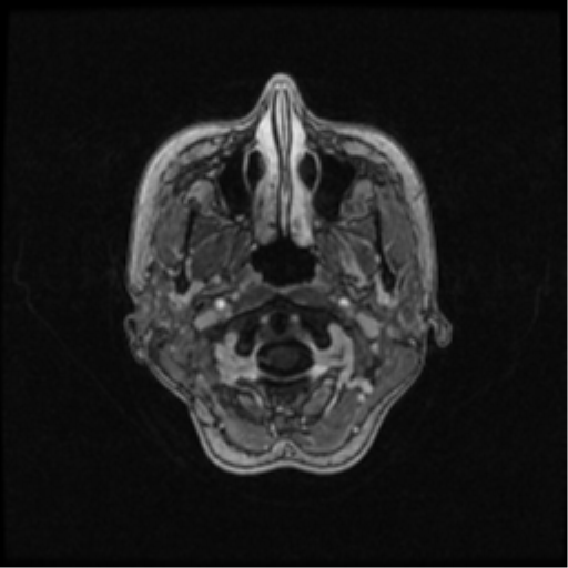 Neurofibromatosis type 2 (Radiopaedia 45229-49244 Axial T1 C+ 21).png