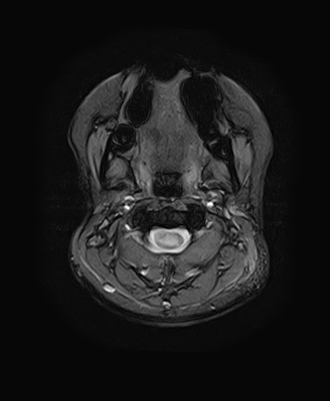 File:Neurofibromatosis type 2 (Radiopaedia 66211-75401 Axial Gradient Echo 3).jpg
