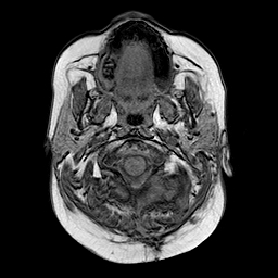 File:Neurofibromatosis type 2 (Radiopaedia 8713-9518 Axial T1 24).jpg