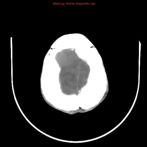 File:Neurofibromatosis type 2 (Radiopaedia 8953-9732 Axial non-contrast 29).jpg