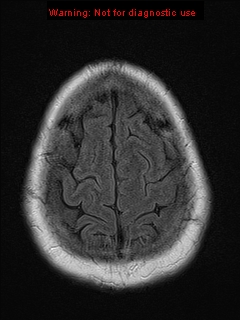 File:Neuroglial cyst (Radiopaedia 10713-11184 Axial FLAIR 3).jpg