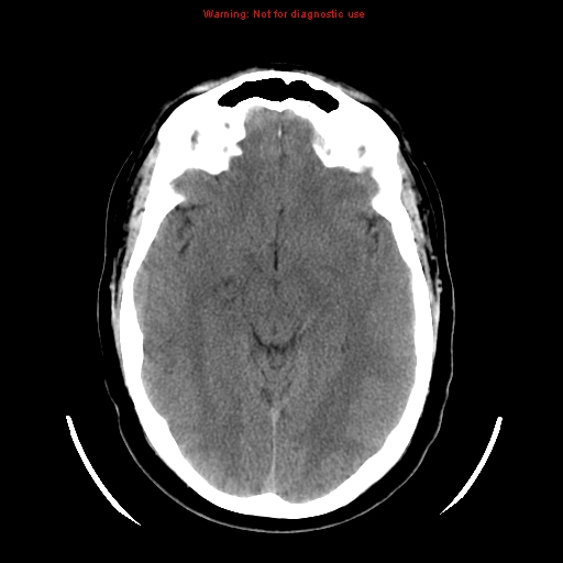 File:Neuroglial cyst (Radiopaedia 10713-11185 Axial non-contrast 19).jpg