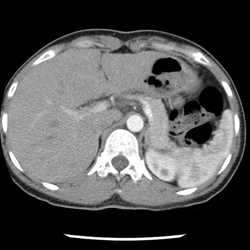 File:Non-small cell lung cancer with miliary metastases (Radiopaedia 23995-24193 A 38).jpg