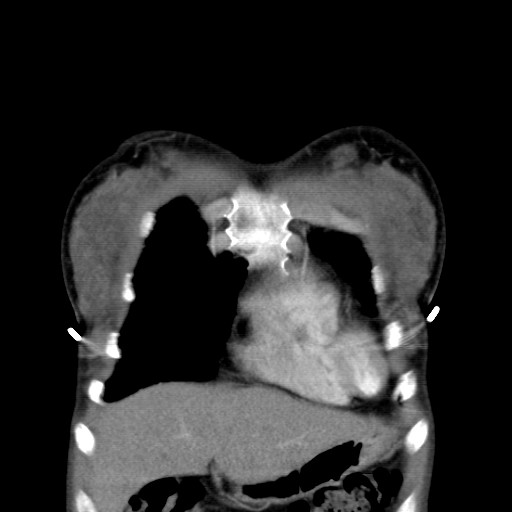 File:Non-small cell lung cancer with miliary metastases (Radiopaedia 23995-24193 B 1).jpg