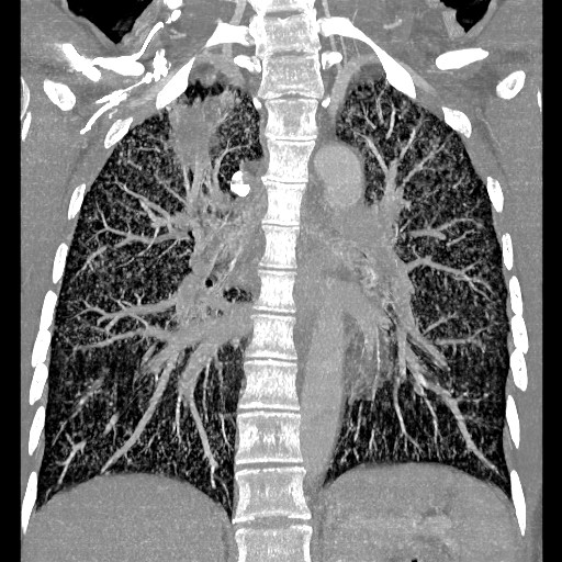 File:Non-small cell lung cancer with miliary metastases (Radiopaedia 23995-24193 Coronal lung window 9).jpg