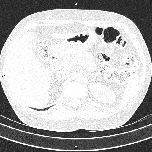 Non-specific interstitial pneumonia (Radiopaedia 83185-97567 Axial lung window 66).jpg