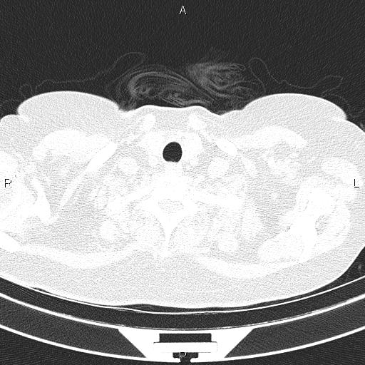 Non-specific interstitial pneumonia (Radiopaedia 83185-97567 Axial lung window 7).jpg