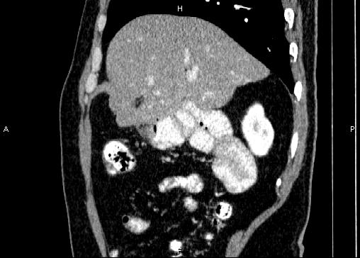 Non-syndromic pancreatic endocrine tumor (Radiopaedia 86958-103178 E 26).jpg