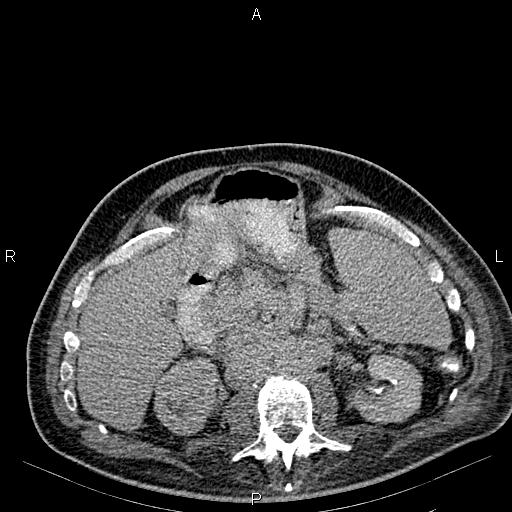 Non Hodgkin lymphoma in a patient with ankylosing spondylitis (Radiopaedia 84323-99621 Axial C+ delayed 28).jpg