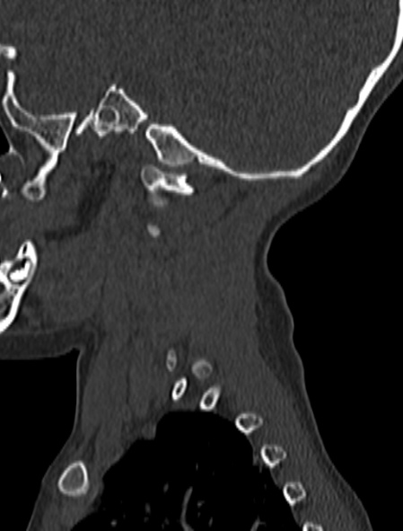 Normal CT cervical spine - pediatric (Radiopaedia 52549-58462 Sagittal bone window 196).jpg