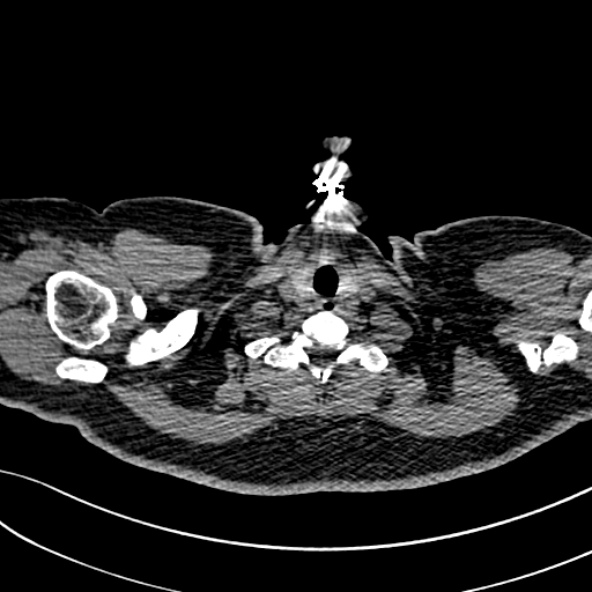 Normal CT chest- adult female (Radiopaedia 52522-58428 Axial non-contrast 5).jpg