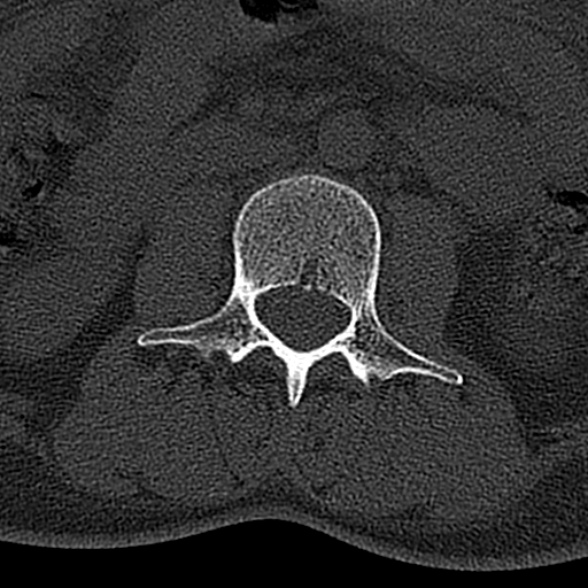 File:Normal CT lumbar spine (Radiopaedia 53981-60118 Axial bone window 35).jpg