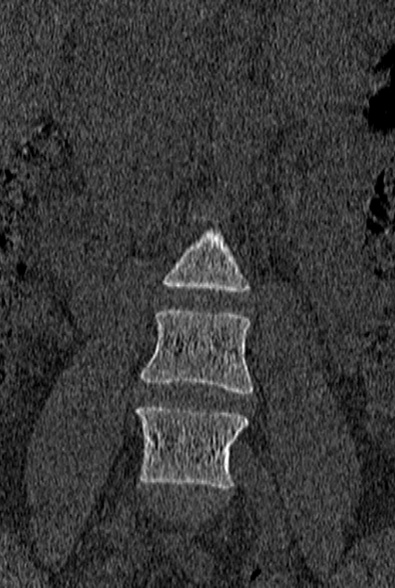 File:Normal CT lumbar spine (Radiopaedia 53981-60118 Coronal bone window 9).jpg