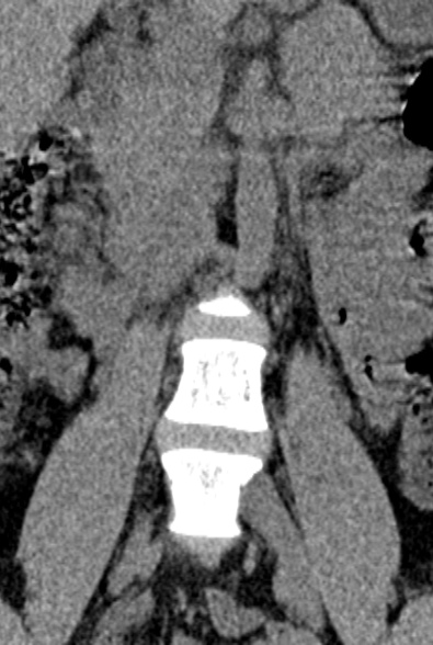 Normal CT lumbar spine (Radiopaedia 53981-60118 F 8).jpg