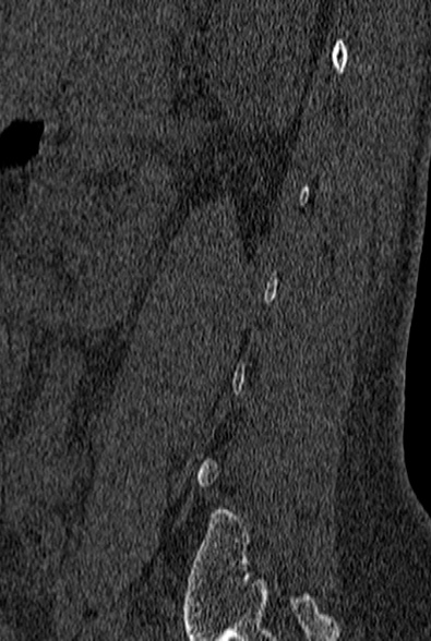 File:Normal CT lumbar spine (Radiopaedia 53981-60118 Sagittal bone window 80).jpg