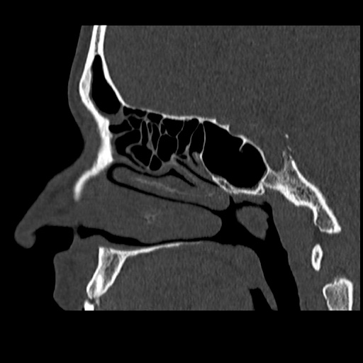 Normal CT paranasal sinuses (Radiopaedia 42286-45390 Sagittal bone window 60).jpg