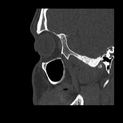 Normal CT paranasal sinuses (Radiopaedia 42286-45390 Sagittal bone window 86).jpg