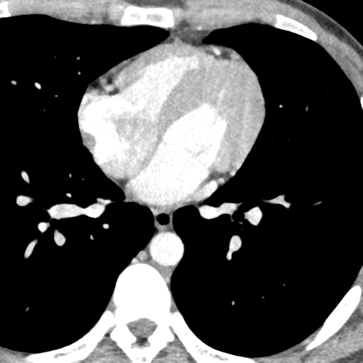 File:Normal CT pulmonary veins (pre RF ablation) (Radiopaedia 41748-44702 A 196).png