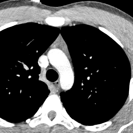 File:Normal CT pulmonary veins (pre RF ablation) (Radiopaedia 41748-44702 A 6).png