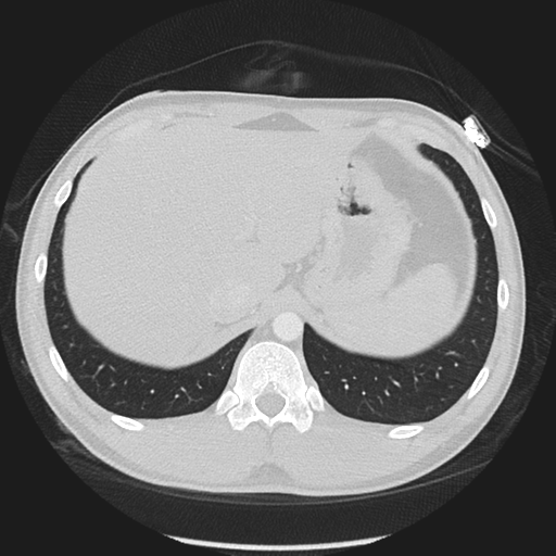 Normal CT pulmonary veins (pre RF ablation) (Radiopaedia 41748-44702 Axial lung window 65).png