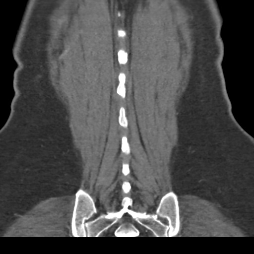 File:Normal CT renal artery angiogram (Radiopaedia 38727-40889 B 69).png