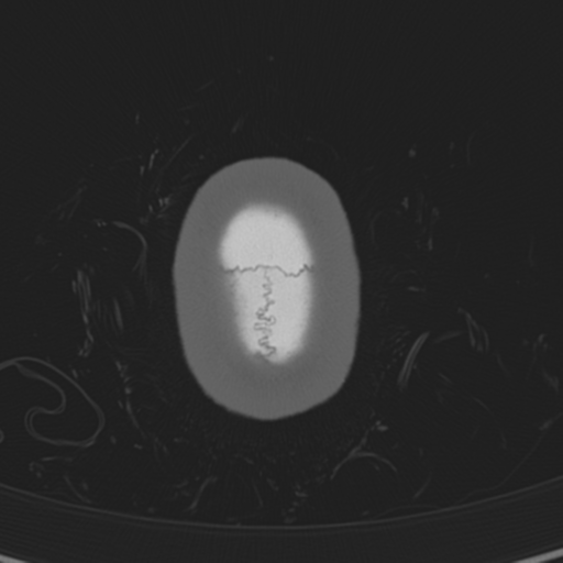 Normal CT skull (Radiopaedia 40798-43459 A 154).png