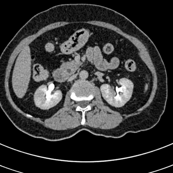 File:Normal CT split bolus study of the renal tract (Radiopaedia 48631-53634 Axial split bolus 70).jpg