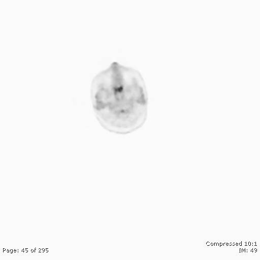File:Normal F-18 FDG PET-CT (Radiopaedia 77382-89510 C 45).jpg