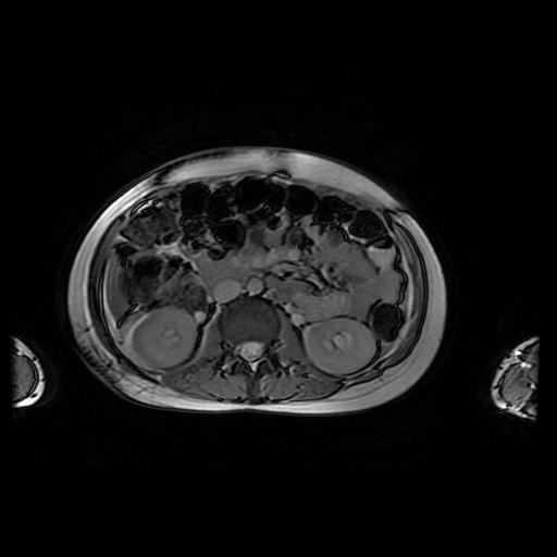 File:Normal MRI abdomen in pregnancy (Radiopaedia 88001-104541 Axial Gradient Echo 23).jpg