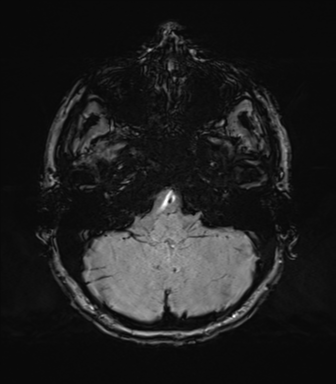 Normal brain MRI (TLE protocol) (Radiopaedia 40748-43405 Axial SWI 16).png