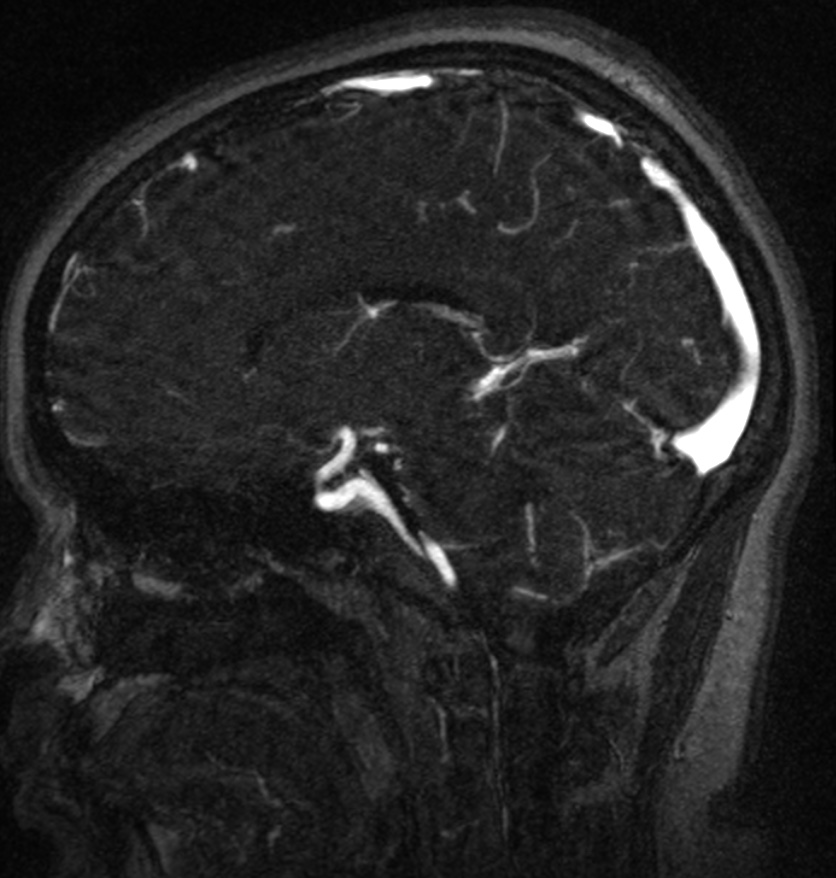 Normal brain MRI and venogram (Radiopaedia 39554-41862 Sagittal MRV 37).jpg