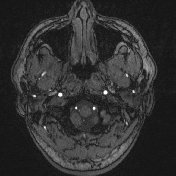 Normal brain MRI including MRA (Radiopaedia 48748-53763 Axial MRA 5).jpg