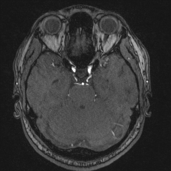 Normal brain MRI including MRA (Radiopaedia 48748-53763 Axial MRA 70).jpg
