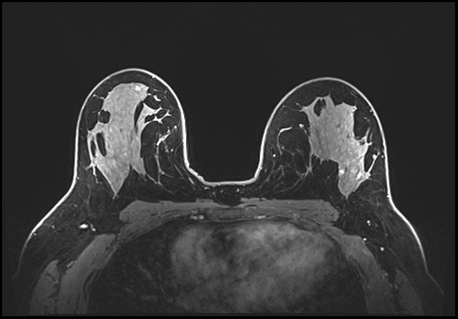 Normal breast MRI - dense breasts (Radiopaedia 80454-93850 C 127).jpg