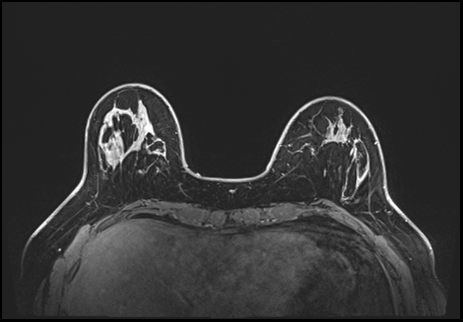 Normal breast MRI - dense breasts (Radiopaedia 80454-93850 C 59).jpg