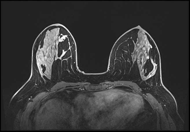Normal breast MRI - dense breasts (Radiopaedia 80454-93850 C 98).jpg