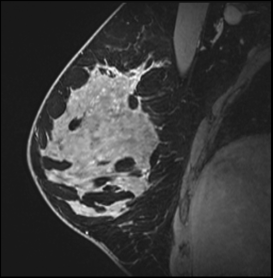 Normal breast MRI - dense breasts (Radiopaedia 80454-93850 I 75).jpg