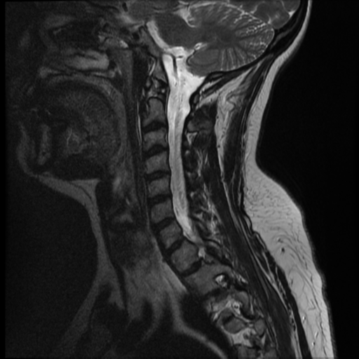File:Normal cervical and thoracic spine MRI (Radiopaedia 35630-37156 Sagittal T2 4).png