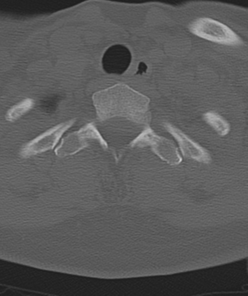 Normal cervical spine MRI (including Dixon) (Radiopaedia 42762-45926 Axial bone window 52).png